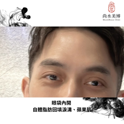 尚水美博心得評價｜眼袋處理+淚溝填補，黑眼圈慢走不送!